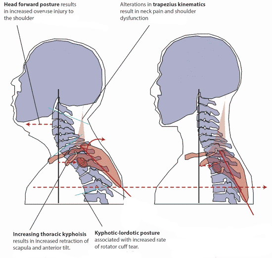 Posture corrector